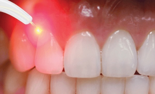 Laser Dentistry – A Modern Way to Improve Your Smile